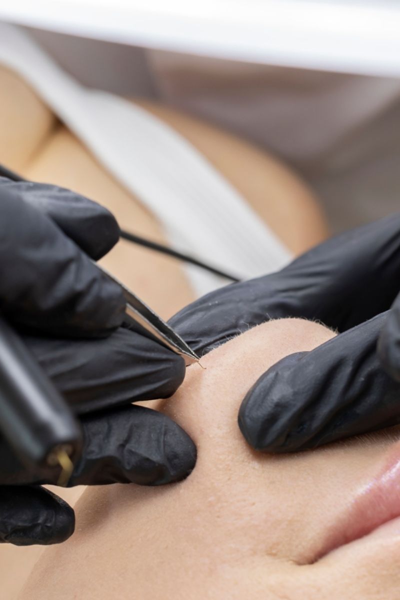 elettrocoagulazione servizio kiwa beauty